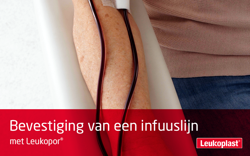 Hier is een close-up van hoe een infuuslijn wordt gefixeerd met behulp van ademende hechtpleister: de handen van een zorgprofessional bevestigen de lijn aan de onderarm van een oudere vrouw met Leukopor. Hier is een close-up van hoe een infuuslijn wordt gefixeerd met behulp van ademende hechtpleister: de handen van een zorgprofessional bevestigen de lijn aan de onderarm van een oudere vrouw met Leukopor.